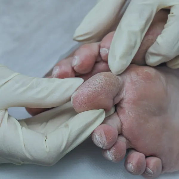 Best Diabetic Foot Management in Ahmedabad