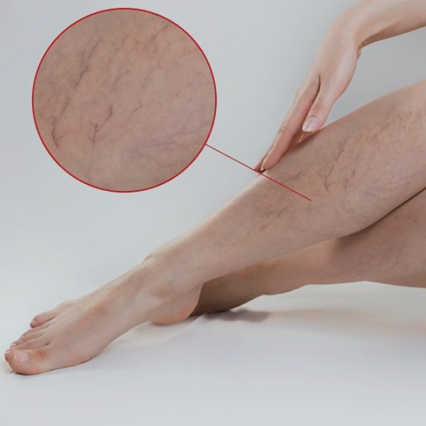 Best Vericose Vein Treatment in Ahmedabad