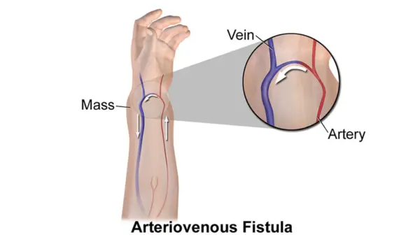 Fistula