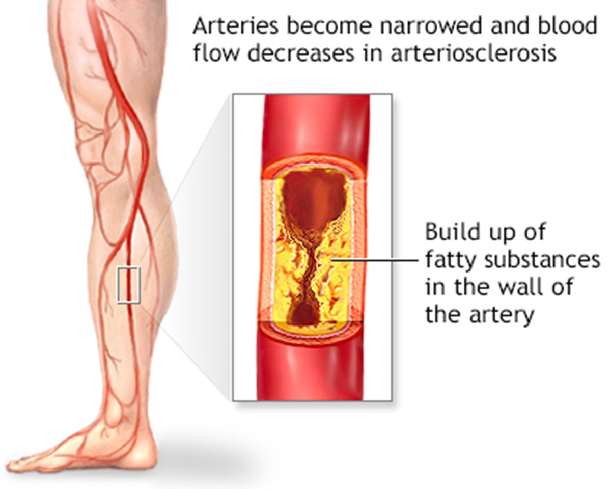 Balloon Angioplasty