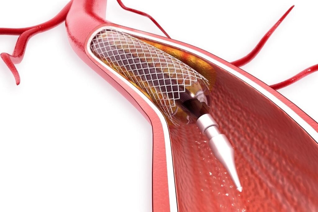 Optional Stenting