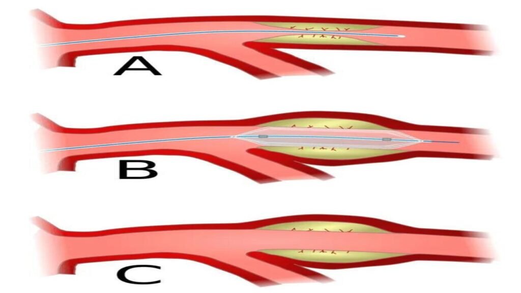Bypass Surgery Treatment