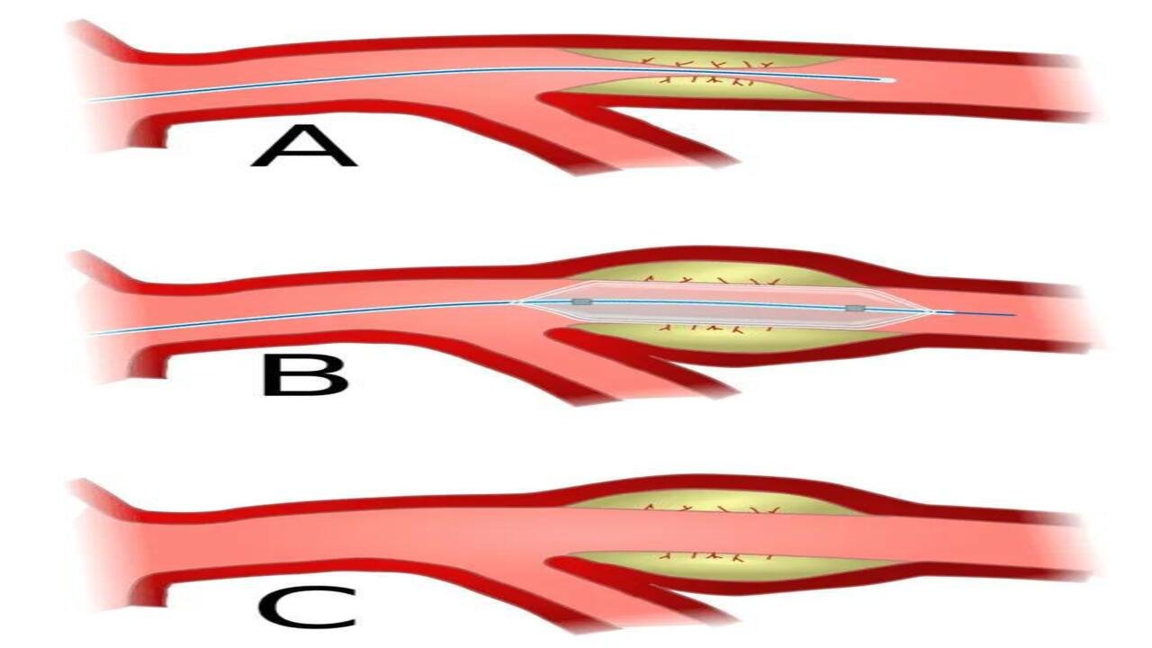 Bypass Surgery Treatment