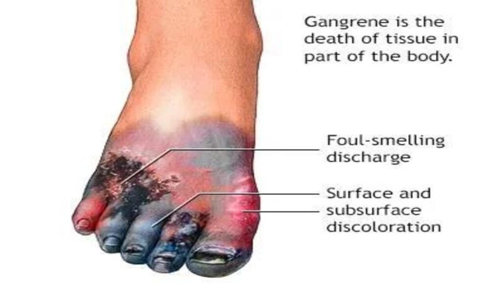 Types of Gangrene