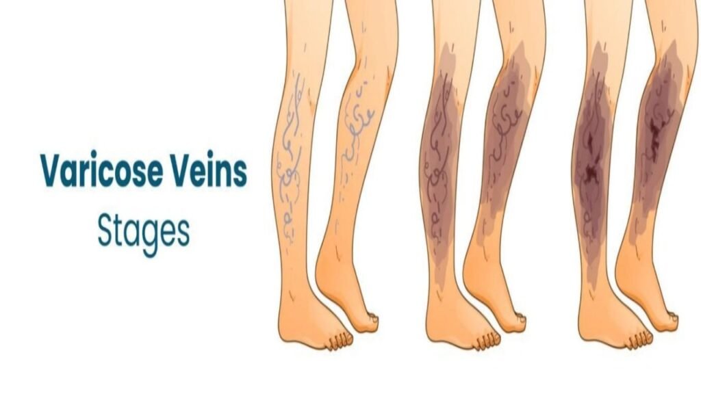 Varicose Veins Stages