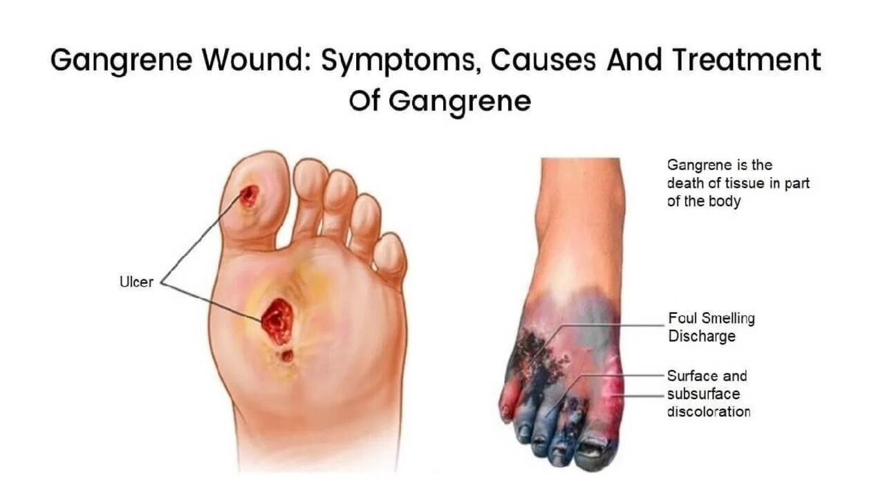 Symptoms of Gangrene