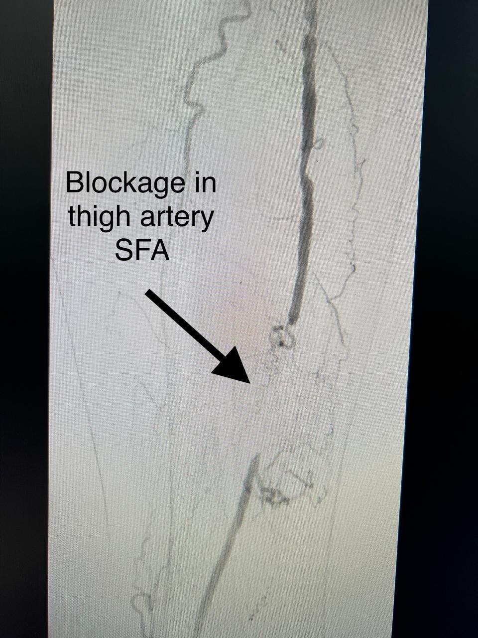 Angioplasty