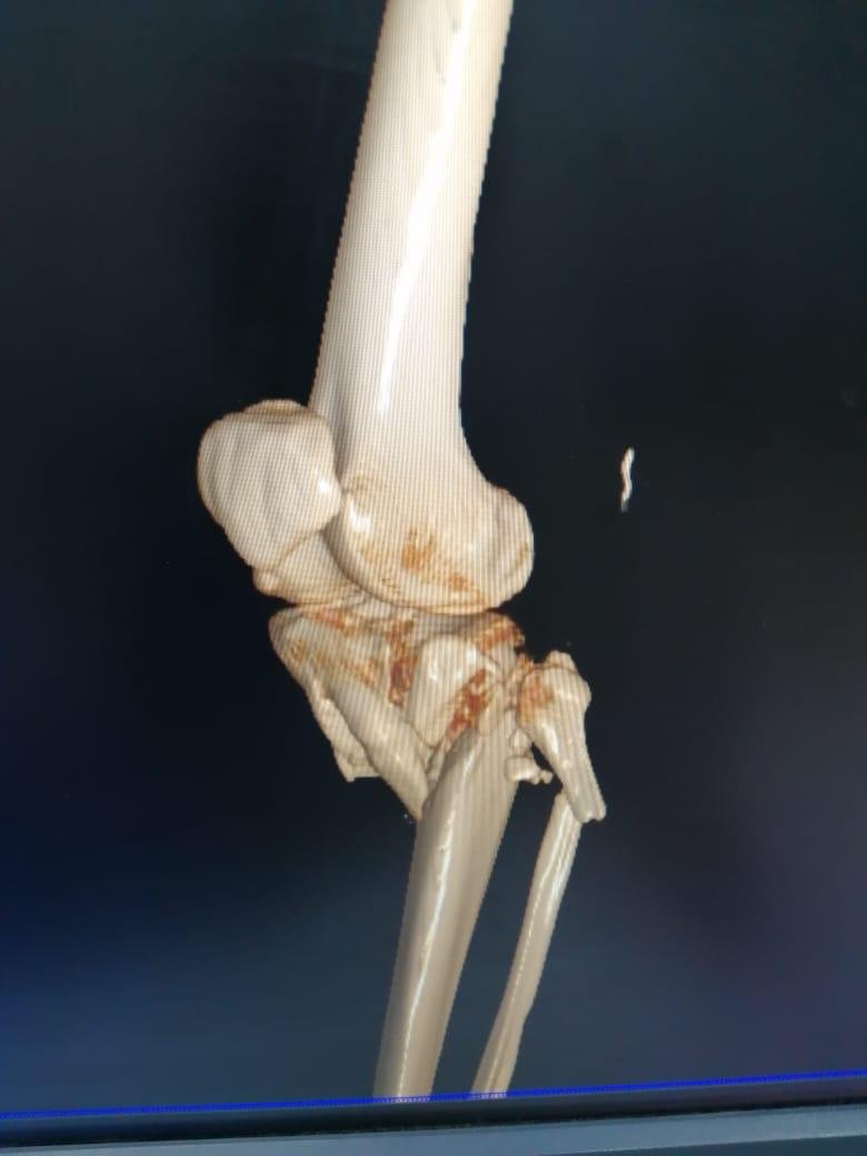 Causes Vascular Trauma
