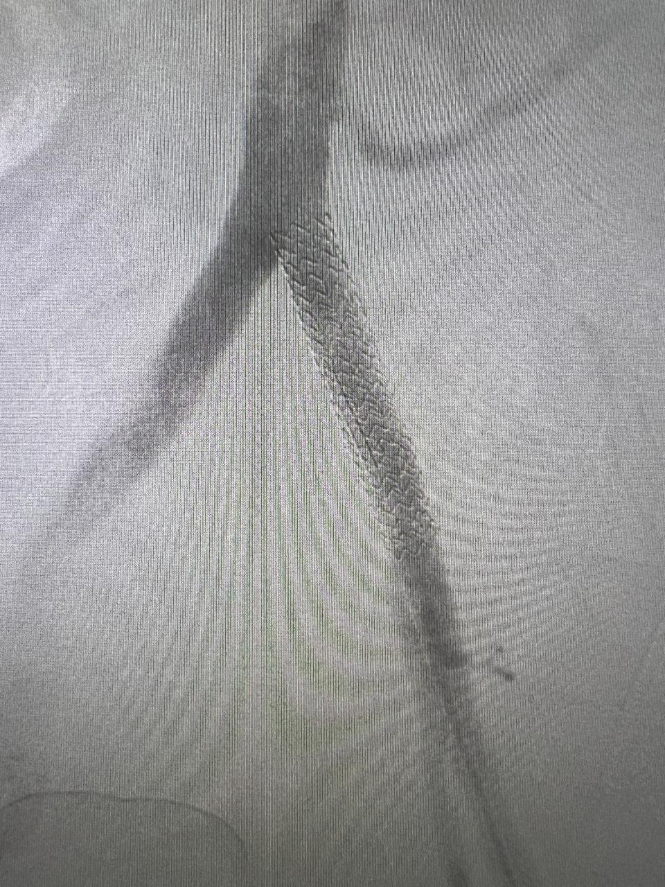 A balloon catheter is inflated inside the vessel