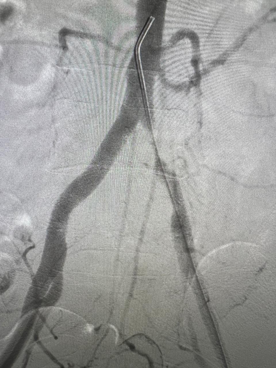 A catheter is inserted into the vessel