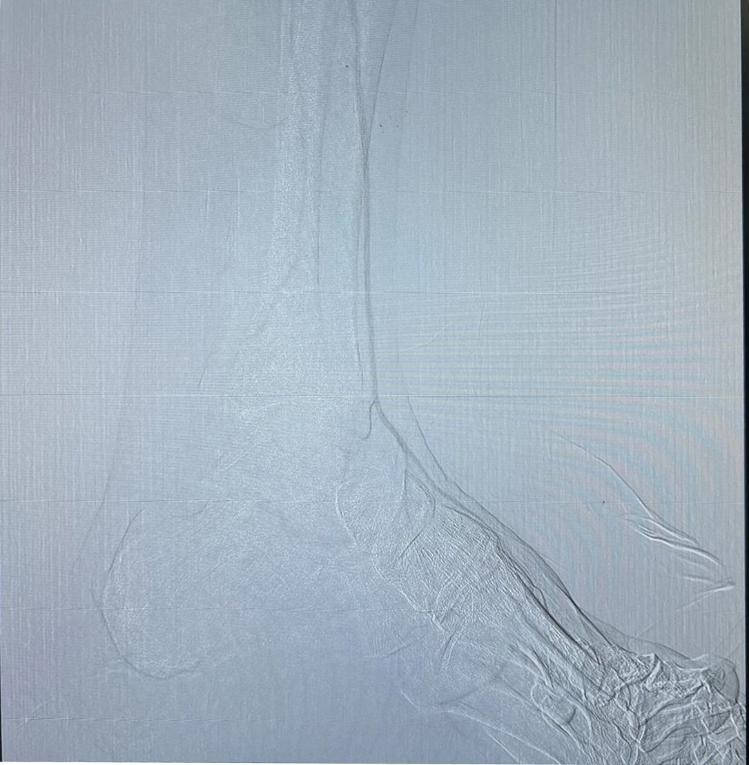 Before angioplasty less blood flow
