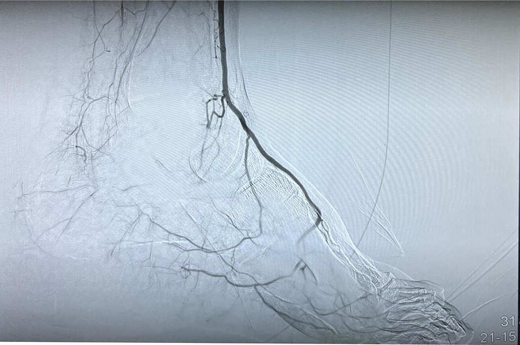 After tibial artery angioplasty