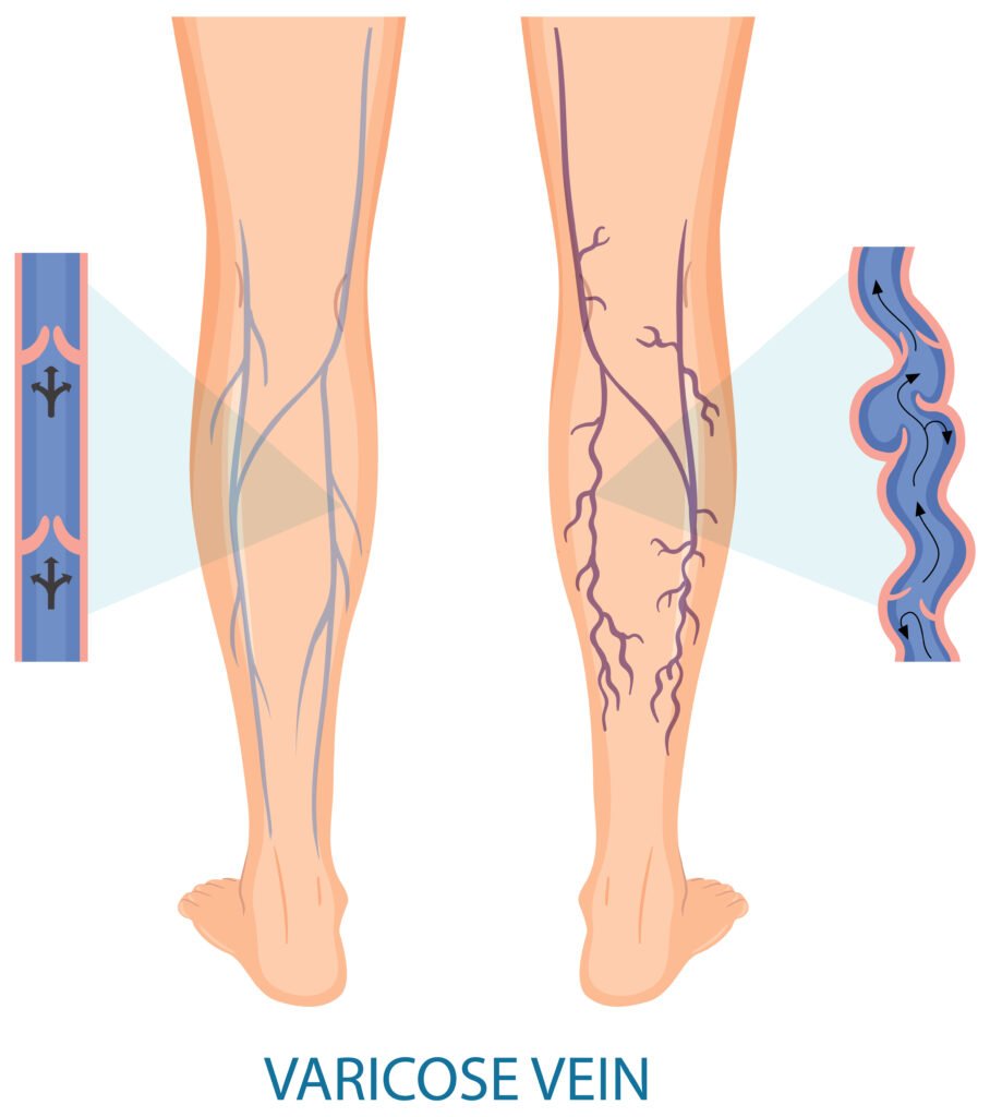 Varicose Veins Treatment by Dr Krunal Gohil